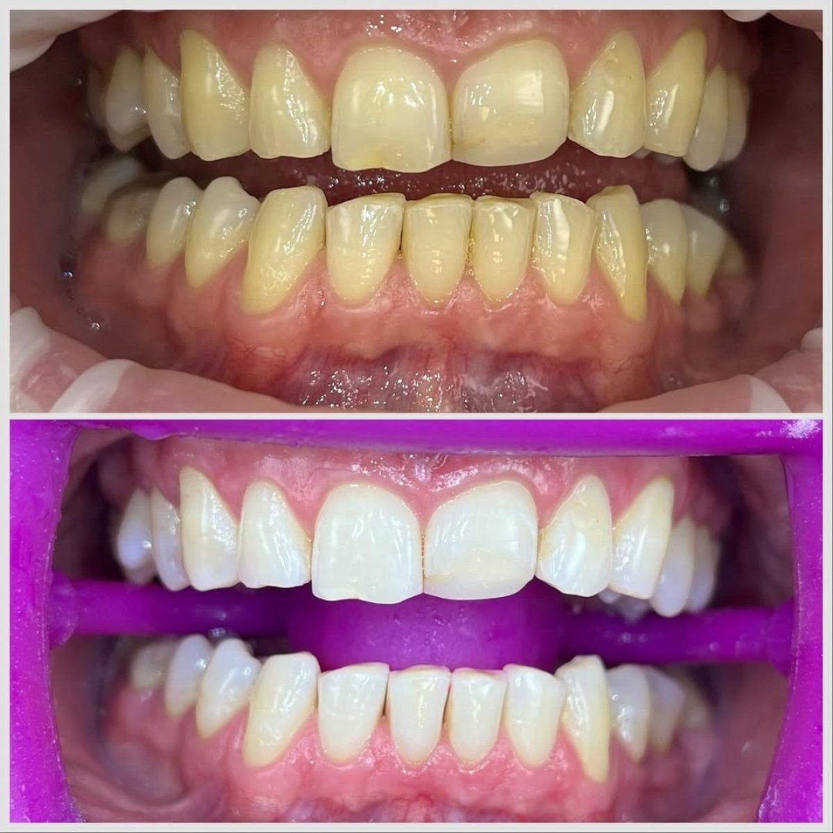 نتائج تنظيف الأسنان (إزالة الجير) قبل وبعد في Smile Centrum – أسنان أكثر بياضًا بوضوح