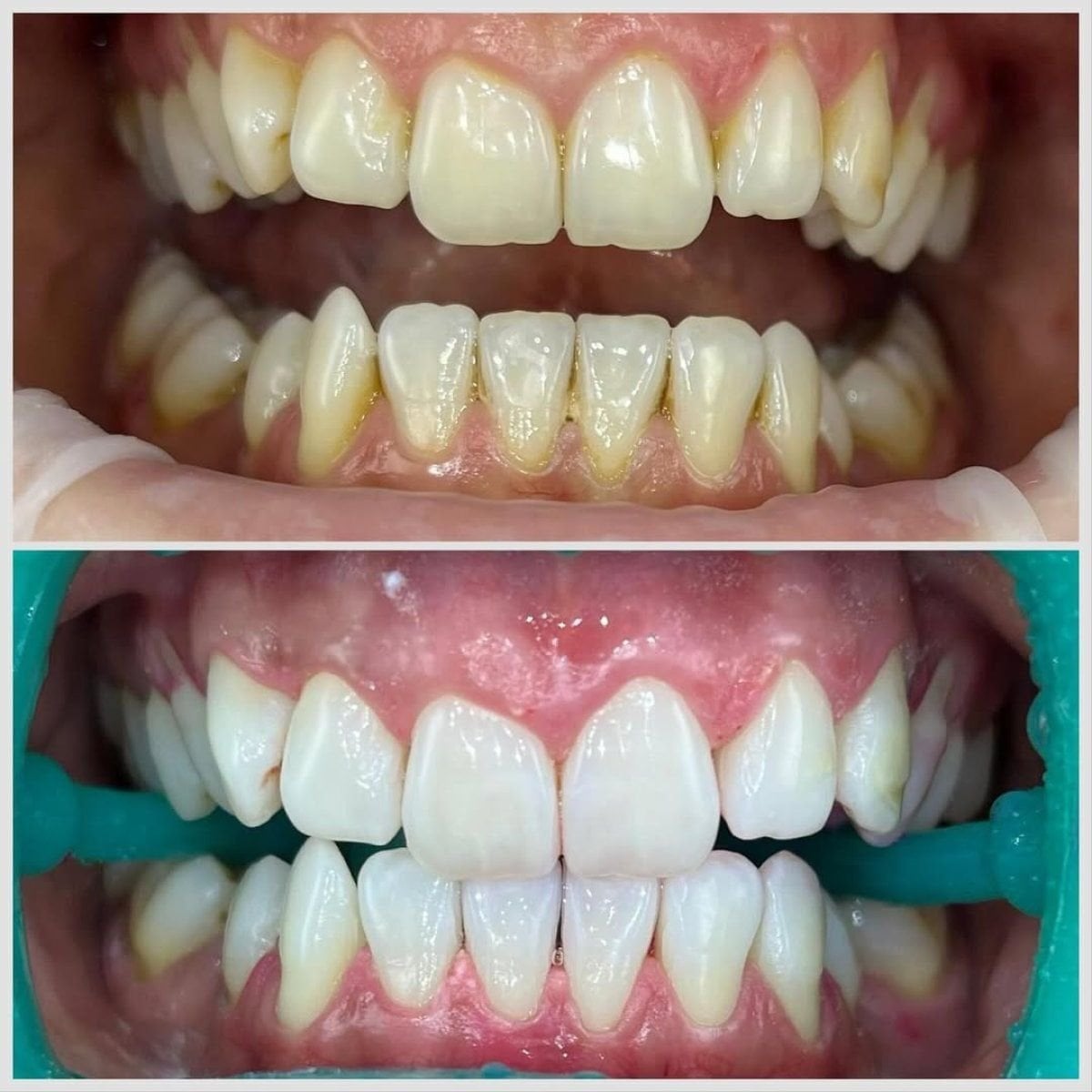 نتائج قبل وبعد تنظيف الأسنان (إزالة الجير) في Smile Centrum – أسنان أكثر بياضًا