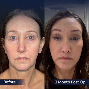 Résultats lifting visage avant/après à la clinique Dr. Safa Manav, rajeunissement visible