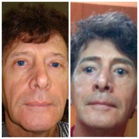 Результаты до и после подтяжки лица в Bangkok Plastic Surgery – омоложение лица