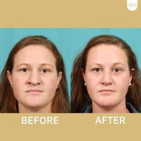 Before and after facelift results at ID Clinic Bangkok, facial rejuvenation and lifted contours