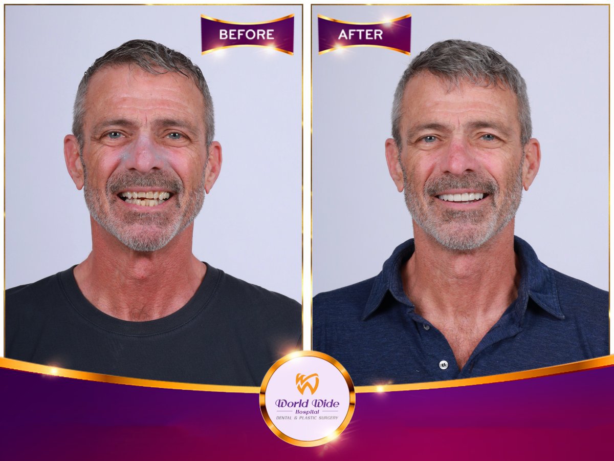 نتائج قبل وبعد ابتسامة هوليود في مستشفى Worldwide Dental & Plastic Surgery
