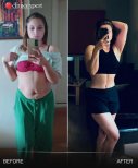 Vorher-nachher-Ergebnis der Bauchliposuktion bei CE International Hospital, schlankere Taille