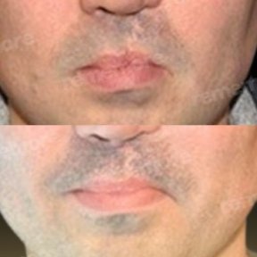 Vorher-nachher-Ergebnisse der Lippenkorrektur bei Spalte im Memorial Bahçelievler Hospital, verbesserte Lippenform