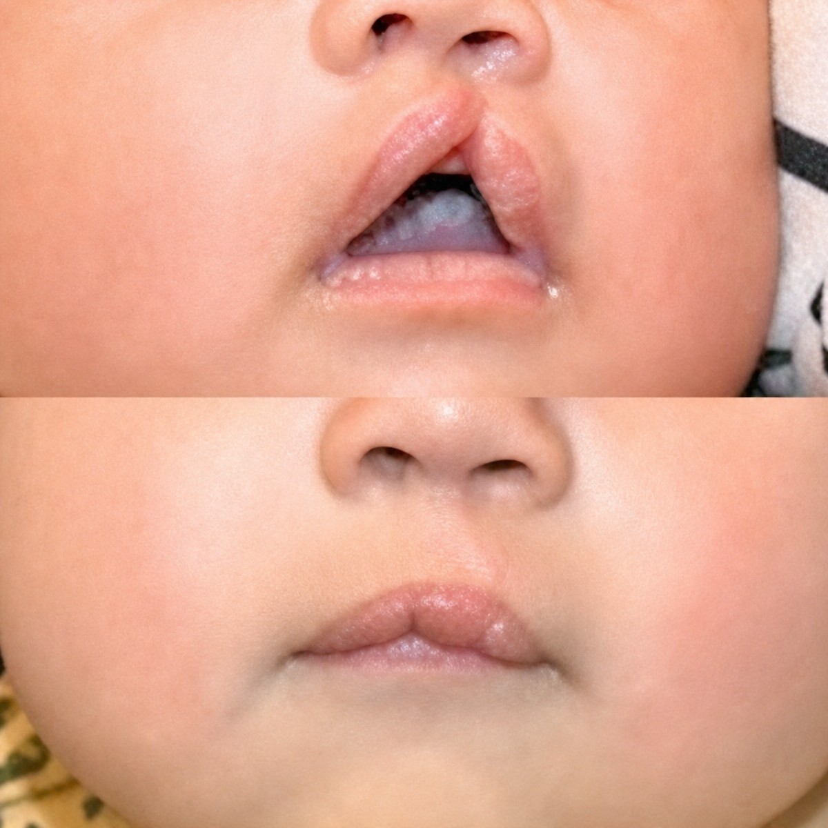 Resultados antes y después de reparación de labio leporino en Memorial Bahçelievler Hospital