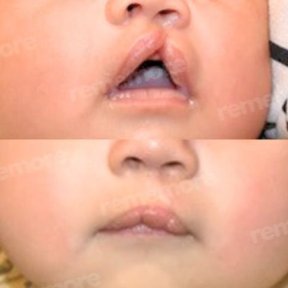 Vorher-nachher-Ergebnis der Lippenkorrektur bei Spaltlippe im Memorial Bahçelievler Hospital