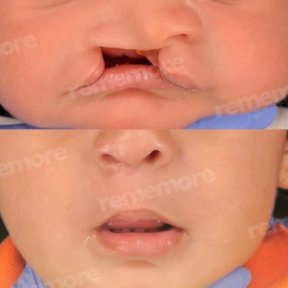 Vorher-nachher-Ergebnis der Lippenkorrektur bei Spalte im Memorial Bahçelievler Hospital