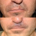 Vorher-nachher-Ergebnisse der Lippenkorrektur bei Spalte im Memorial Bahçelievler Hospital