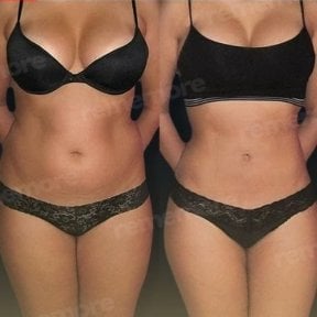 Результати до та після кругової підтяжки тіла в Memorial Bahçelievler Hospital, покращений контур