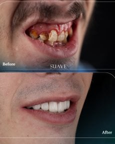 Before and after zirconia crown installation at SUAVE DENTAL CLINIC, smile restoration result