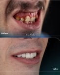 Before and after zirconia crown installation at SUAVE DENTAL CLINIC, smile restoration result
