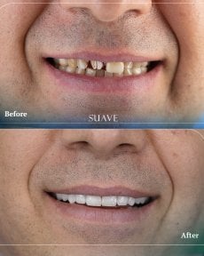 Before and after zirconia crown installation at SUAVE DENTAL CLINIC, smile transformation result
