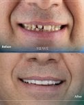 Before and after zirconia crown installation at SUAVE DENTAL CLINIC, smile transformation result
