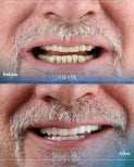 Before and after zirconia crown results at SUAVE DENTAL CLINIC – smile restoration