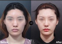 Vorher-nachher-Ergebnis der Jochbeinreduktion bei VG Plastic Surgery, verbesserte Gesichtskontur