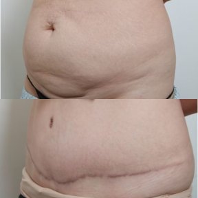 نتائج قبل وبعد عملية تجميل الأم في URBAN Plastic Surgery، تحسين شكل البطن