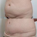 نتائج قبل وبعد عملية تجميل الأم في URBAN Plastic Surgery، تحسين شكل البطن