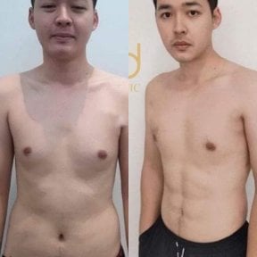 Before and after liposuction results at ID Clinic Bangkok, improved male body contour