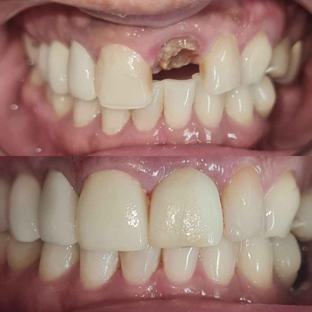 Before and after dental implant results at SoftDentalCare Clinic – restored front teeth smile