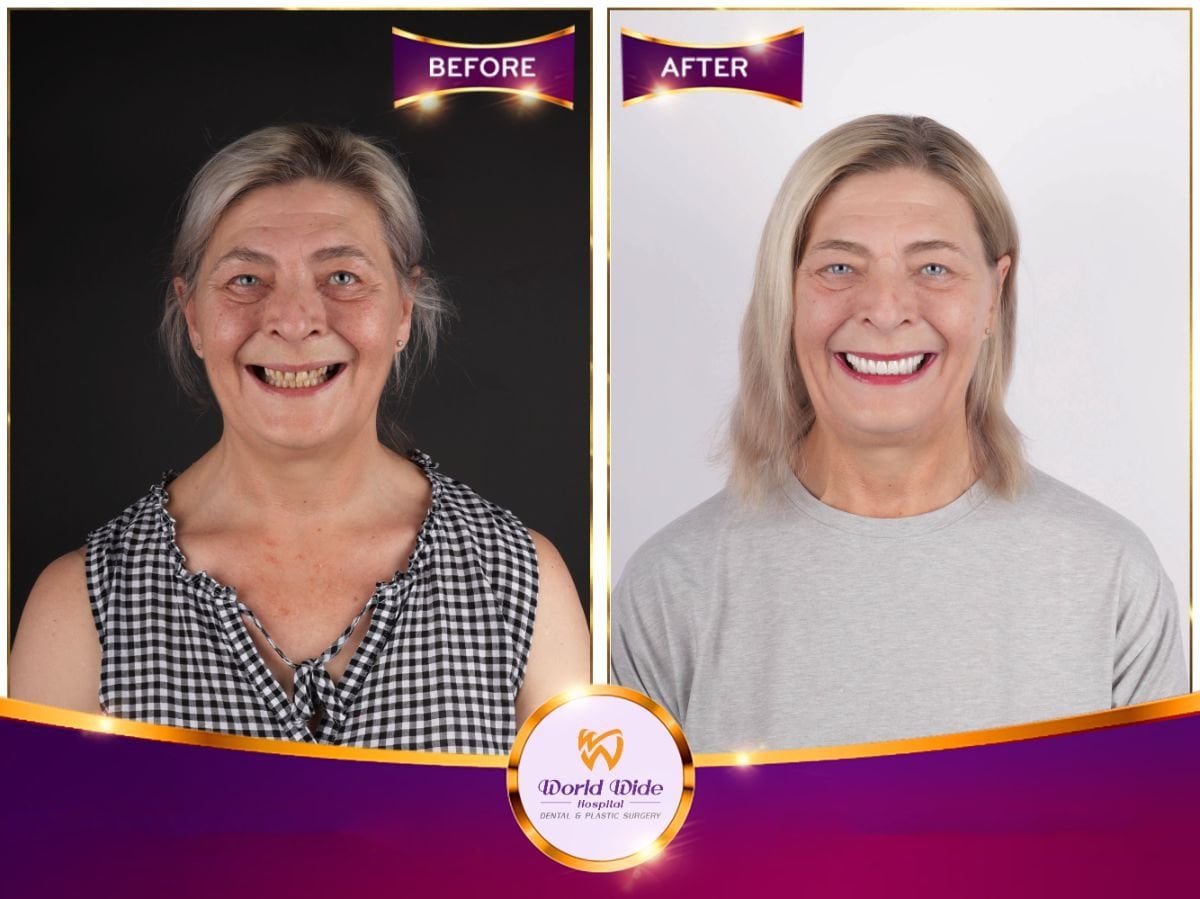 نتيجة قبل وبعد زراعة أسنان All-on-6 في مستشفى Worldwide Dental & Plastic Surgery