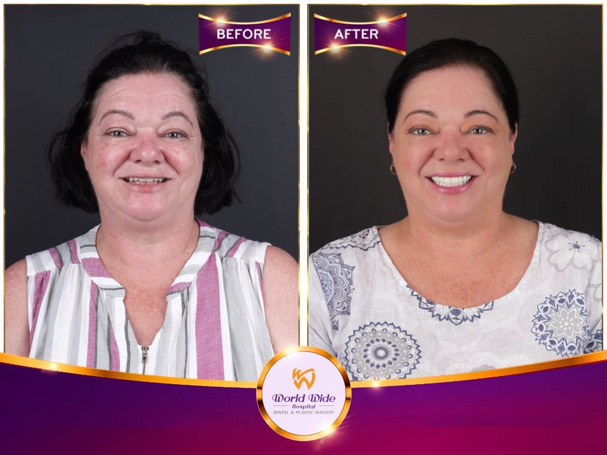 نتيجة زراعة أسنان All-on-6 قبل وبعد في مستشفى Worldwide Dental & Plastic Surgery