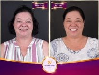 Before and after All-on-6 dental implants result at Worldwide Dental & Plastic Surgery Hospital