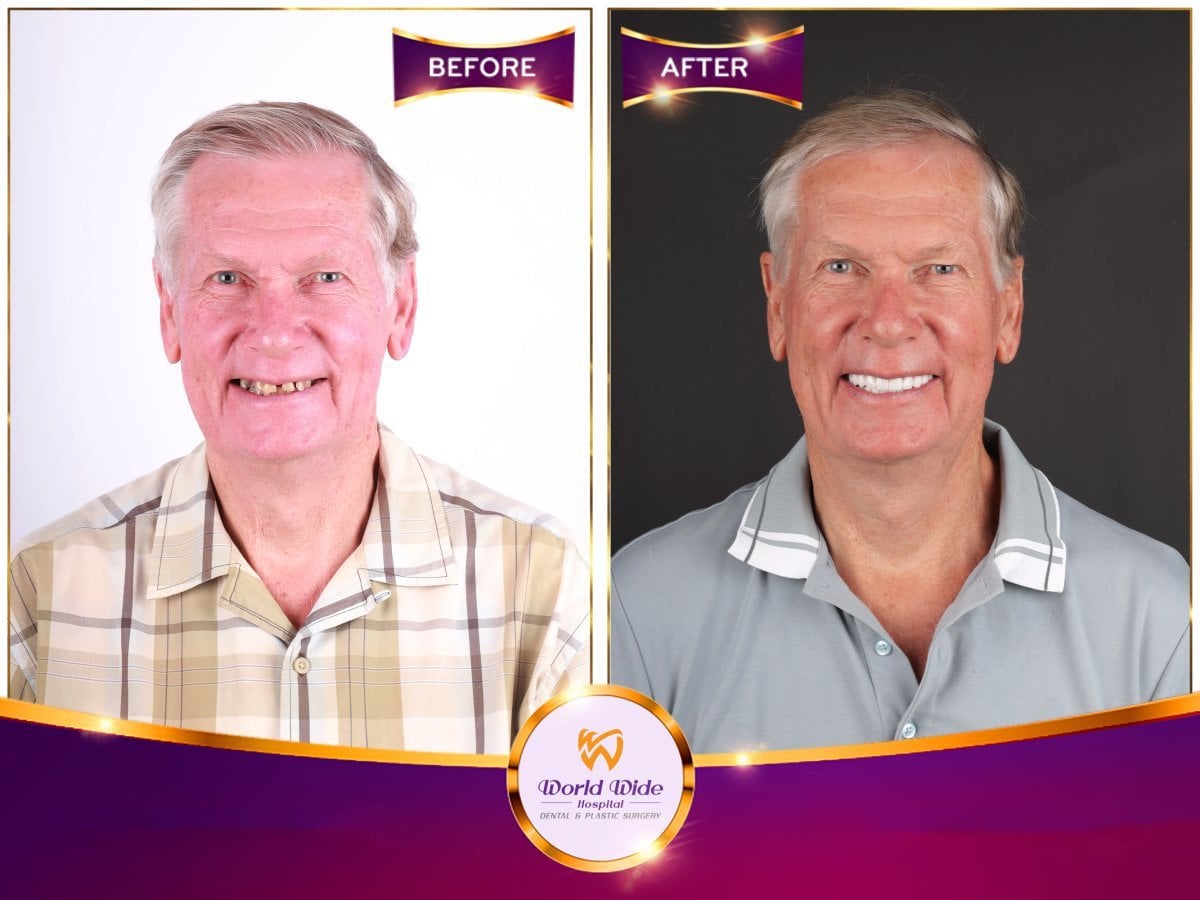 نتيجة قبل وبعد زراعة الأسنان All-on-6 في مستشفى Worldwide Dental & Plastic Surgery
