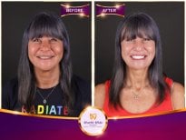 Résultats avant et après Hollywood Smile à Worldwide Dental & Plastic Surgery Hospital