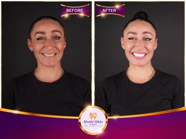 Résultats avant et après Hollywood Smile à Worldwide Dental & Plastic Surgery Hospital