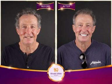 Résultats avant/après Hollywood Smile à Worldwide Dental & Plastic Surgery Hospital