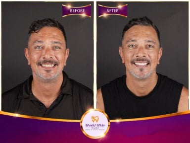 Résultats avant et après Hollywood Smile à Worldwide Dental & Plastic Surgery Hospital
