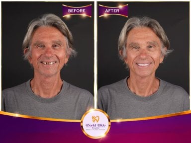 Résultats avant et après Hollywood Smile à Worldwide Dental & Plastic Surgery Hospital
