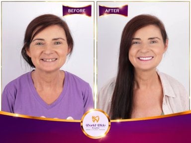 Résultats avant et après Hollywood Smile à Worldwide Dental & Plastic Surgery Hospital