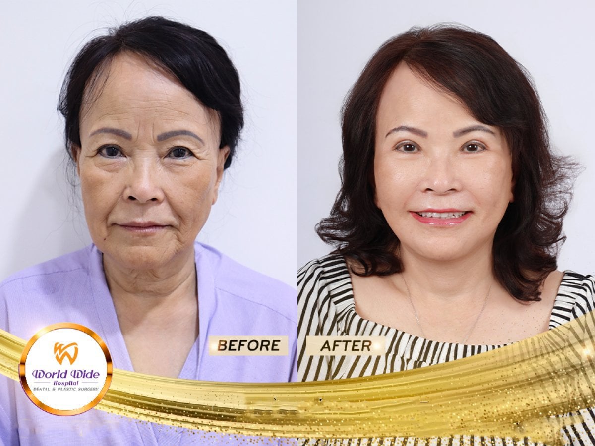 نتائج شد الوجه قبل وبعد في مستشفى Worldwide Dental & Plastic Surgery، وجه أكثر شباباً