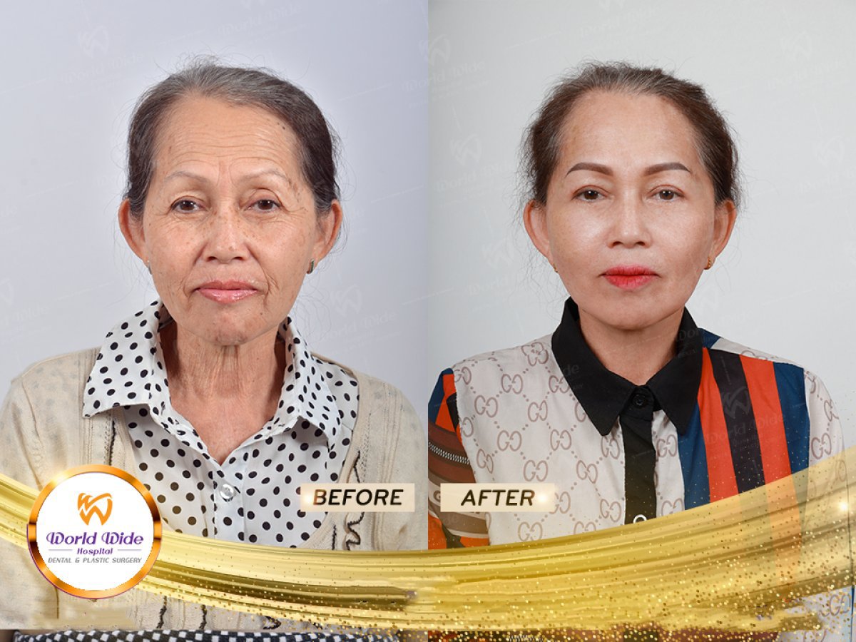 Resultados de lifting facial antes y después en Worldwide Dental & Plastic Surgery Hospital, rejuvenecimiento