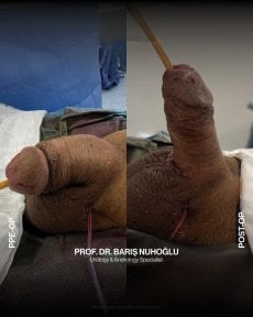 Результаты до и после фаллопротезирования в Men's Health Clinics, улучшение эрекции