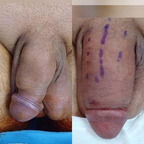 Before and after penis enlargement results at Men's Health Clinics, visible size improvement