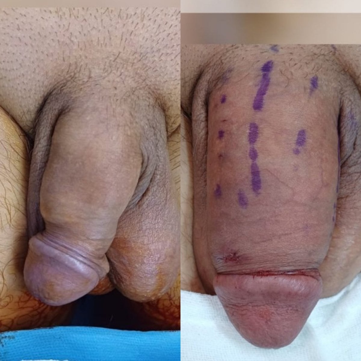 Resultados antes y después de relleno de pene en Men's Health Clinics – mayor grosor visible