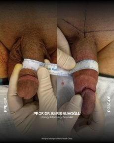 Before and after penis enlargement results at Men's Health Clinics, visible length increase
