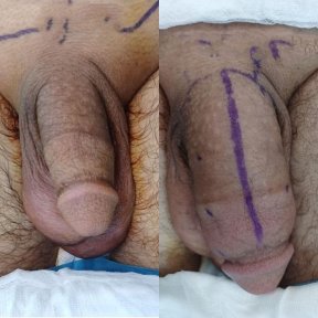 Before and after penis enlargement results at Men's Health Clinics – visible girth increase
