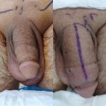 Before and after penis enlargement results at Men's Health Clinics – visible girth increase