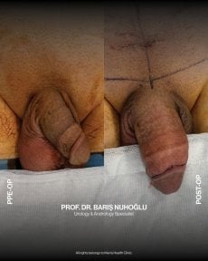 Before and after penis enlargement results at Men's Health Clinics, visible size improvement