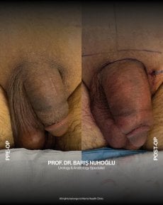 Resultados de antes y después de aumento de pene en Men's Health Clinics, mejora visible