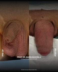 Resultados antes y después de aumento de pene en Men's Health Clinics, mejora visible