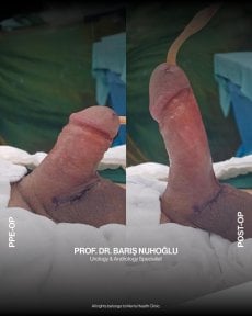 Before and after penile implant surgery results at Men's Health Clinics, improved function shown