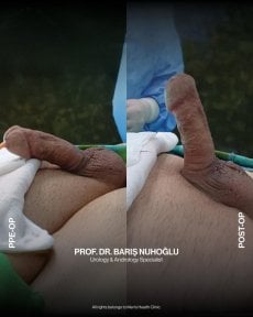 Efekty przed i po wszczepieniu implantu prącia w Men's Health Clinics, poprawa funkcji