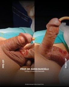 Результаты до и после фаллопротезирования в Men's Health Clinics, улучшена функция