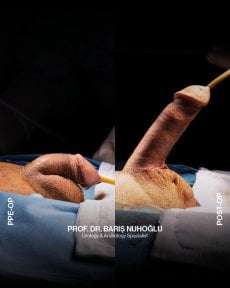 Результаты до и после фаллопротезирования в Men's Health Clinics, улучшение функции