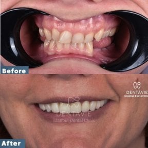 Before and after All-on-4 dental implants result at Dentavie Istanbul Dental Clinic, smile restored