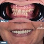 Before and after All-on-4 dental implants result at Dentavie Istanbul Dental Clinic, smile restored